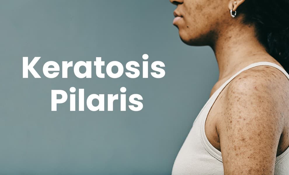 Keratosis pilaris on arm, Rough skin with small bumps, Close-up of keratosis pilaris, Dry bumpy skin texture, Skin condition keratosis pilaris