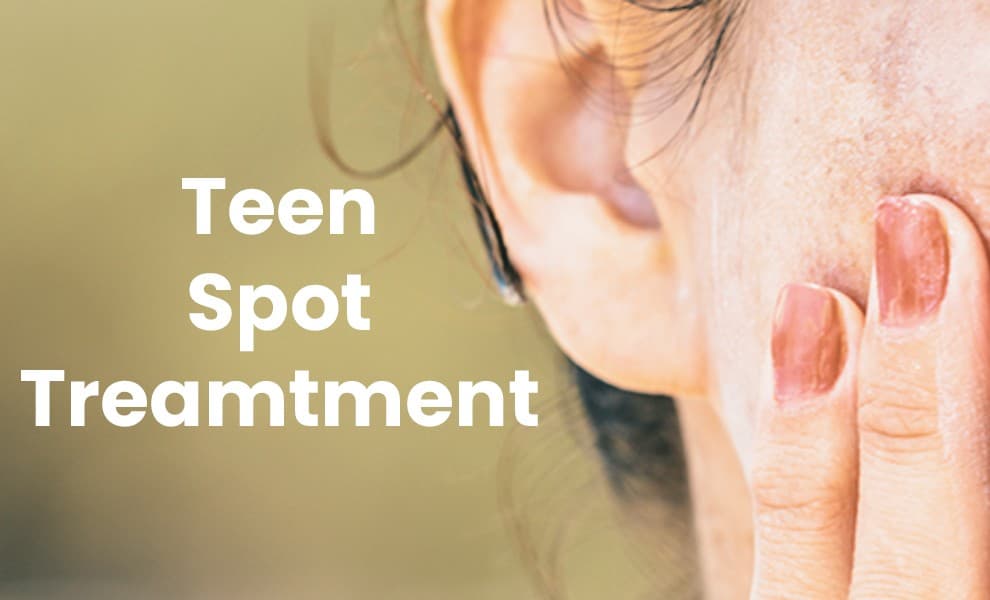 Teen spot treatment tube, Acne spot gel for teens, Pimple cream for teenage skin, Blemish treatment for teens, Gentle acne spot treatment