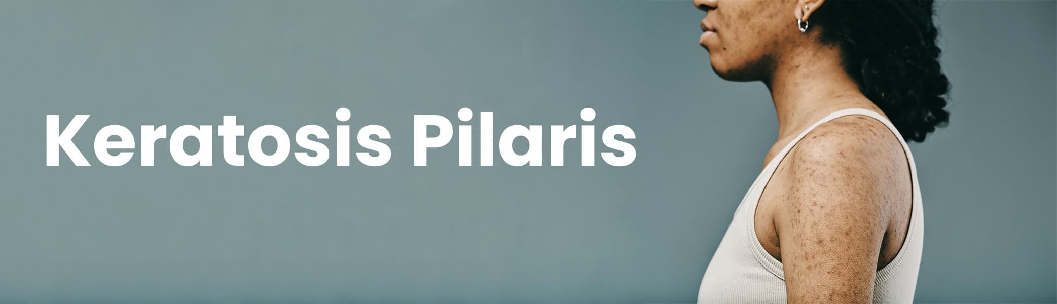 Keratosis pilaris on arm, Rough skin with small bumps, Close-up of keratosis pilaris, Dry bumpy skin texture, Skin condition keratosis pilaris